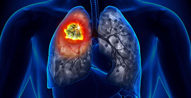 Akciğer kanserinin yüzde 90’ı sigaradan kaynaklanıyor!